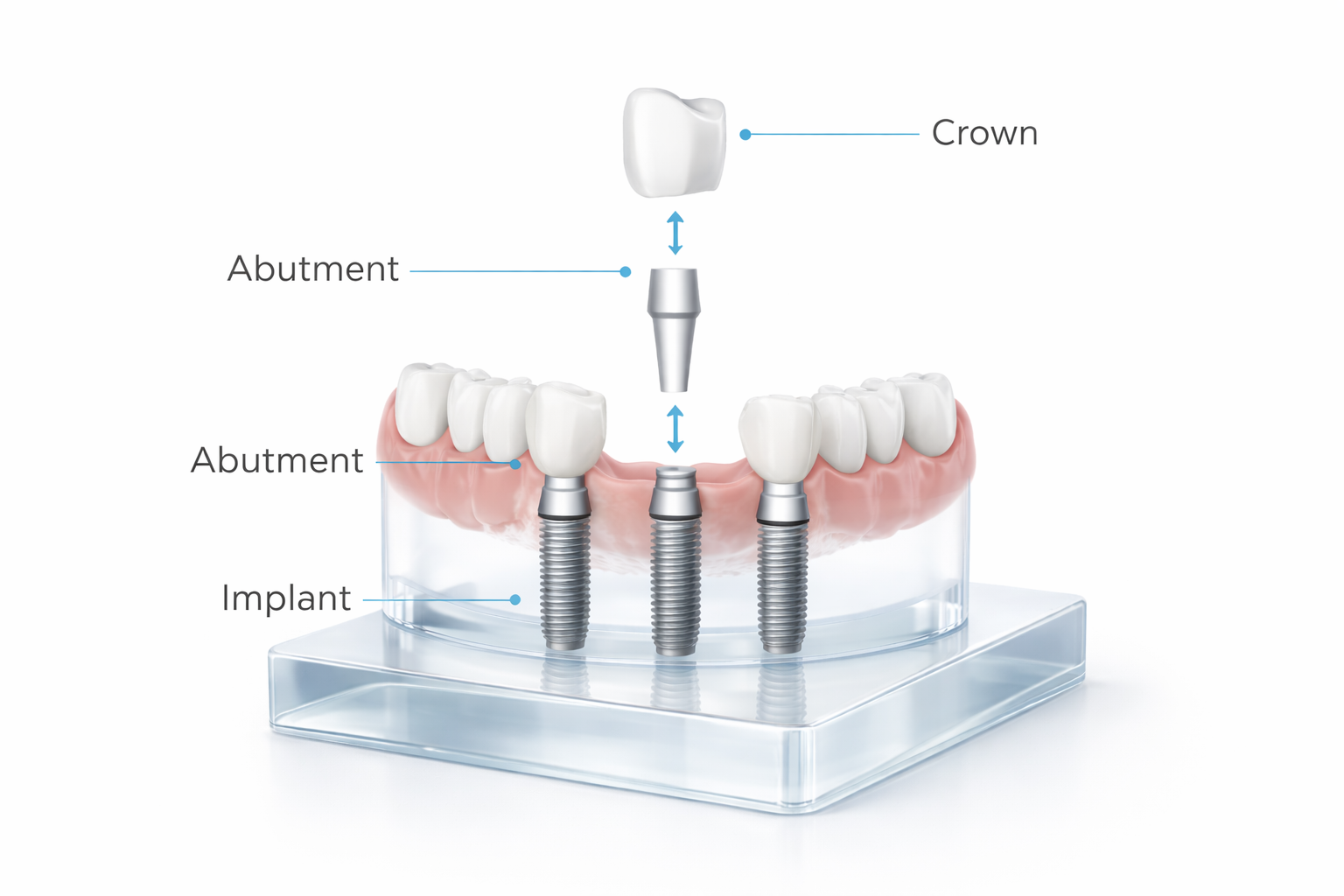 Dental Implant Anatomy